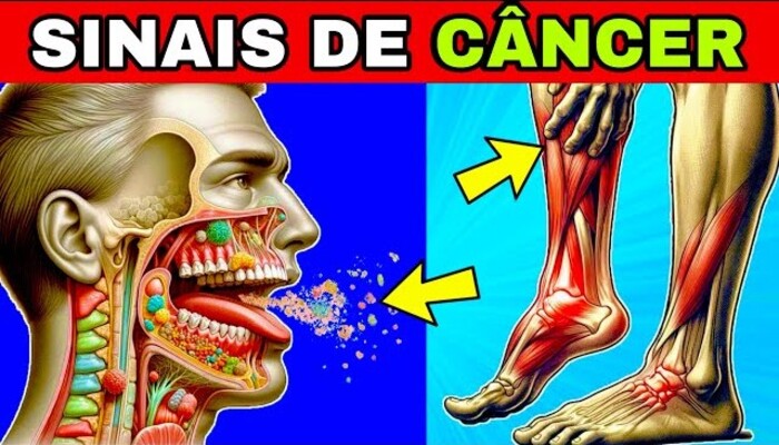CÂNCER