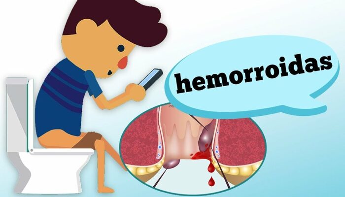 hemorroida
