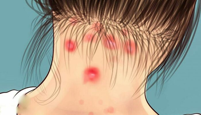 fibromialgia