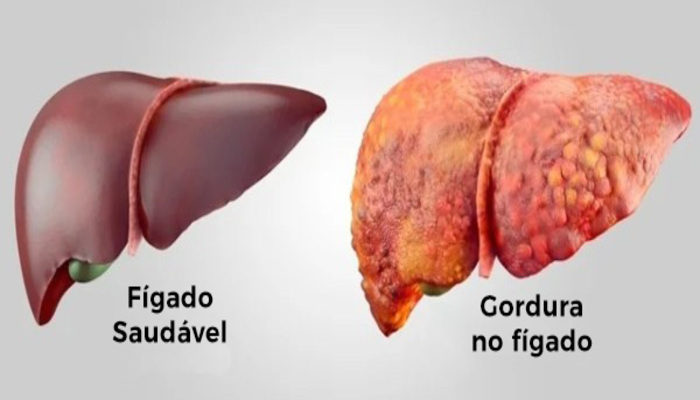 Sinais de Que Você Está com Gordura no Fígado